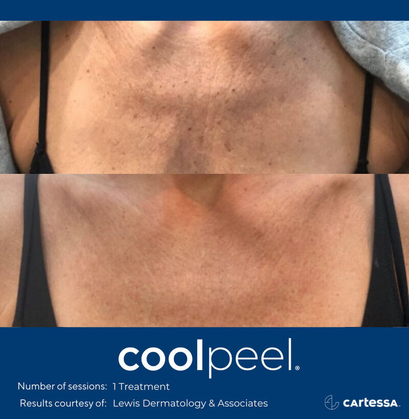 CoolPeel Before & After Image