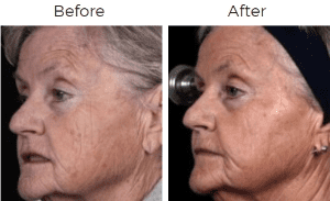 Fraxel Before & After Image