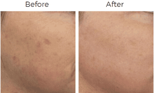 Fraxel Before & After Image