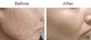 Photofacial IPL Before & After Image