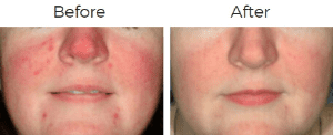 Photofacial IPL Before & After Image