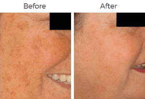 Photofacial IPL Before & After Image