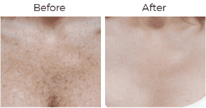 Photofacial IPL Before & After Image