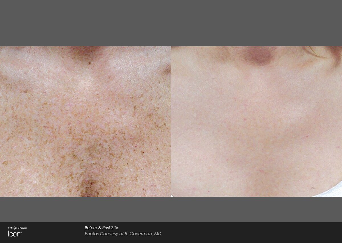 Photofacial IPL Before & After Image
