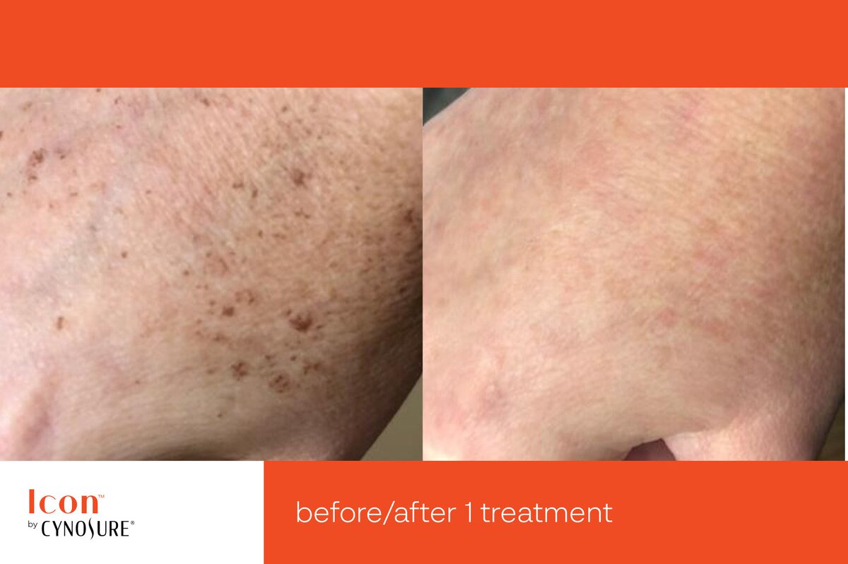 Photofacial IPL Before & After Image