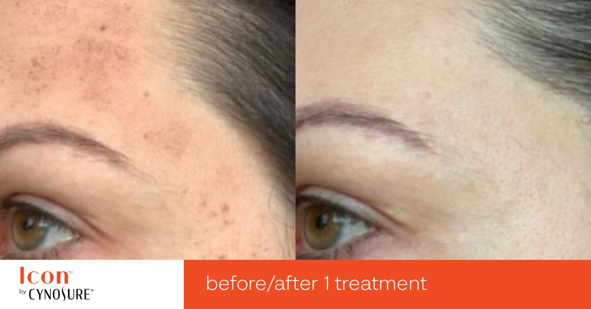 Photofacial IPL Before & After Image