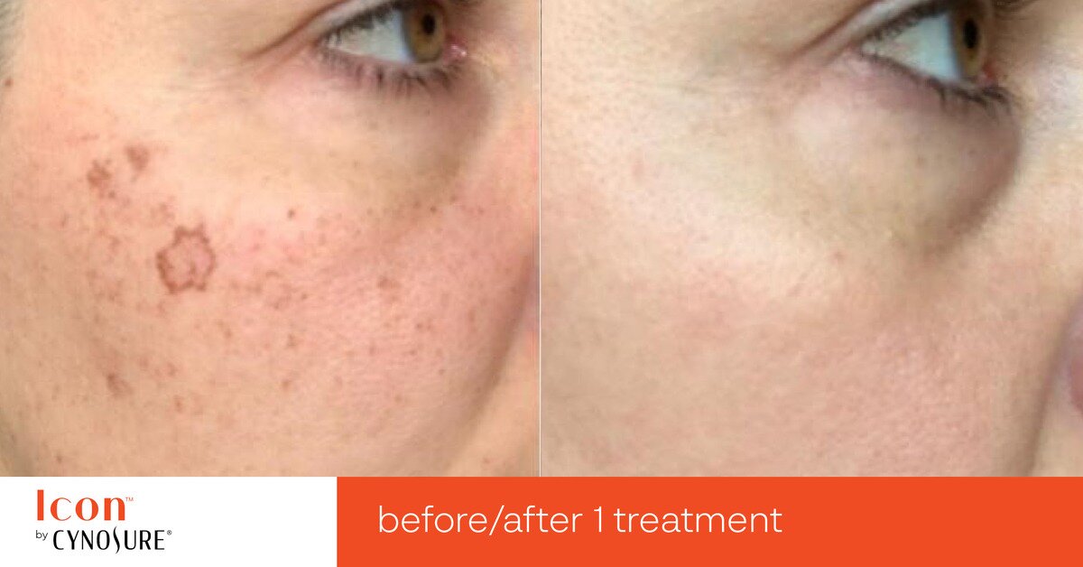 Photofacial IPL Before & After Image