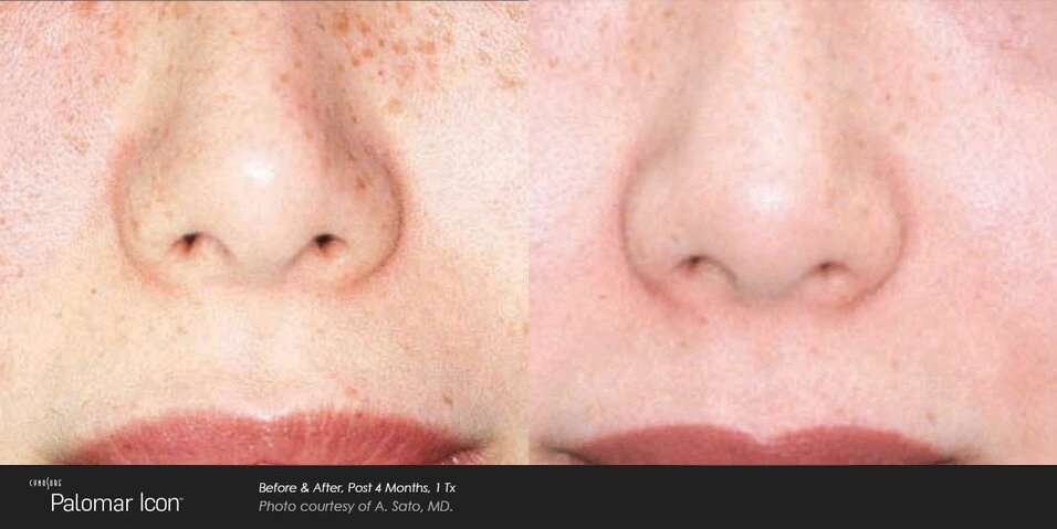 Photofacial IPL Before & After Image