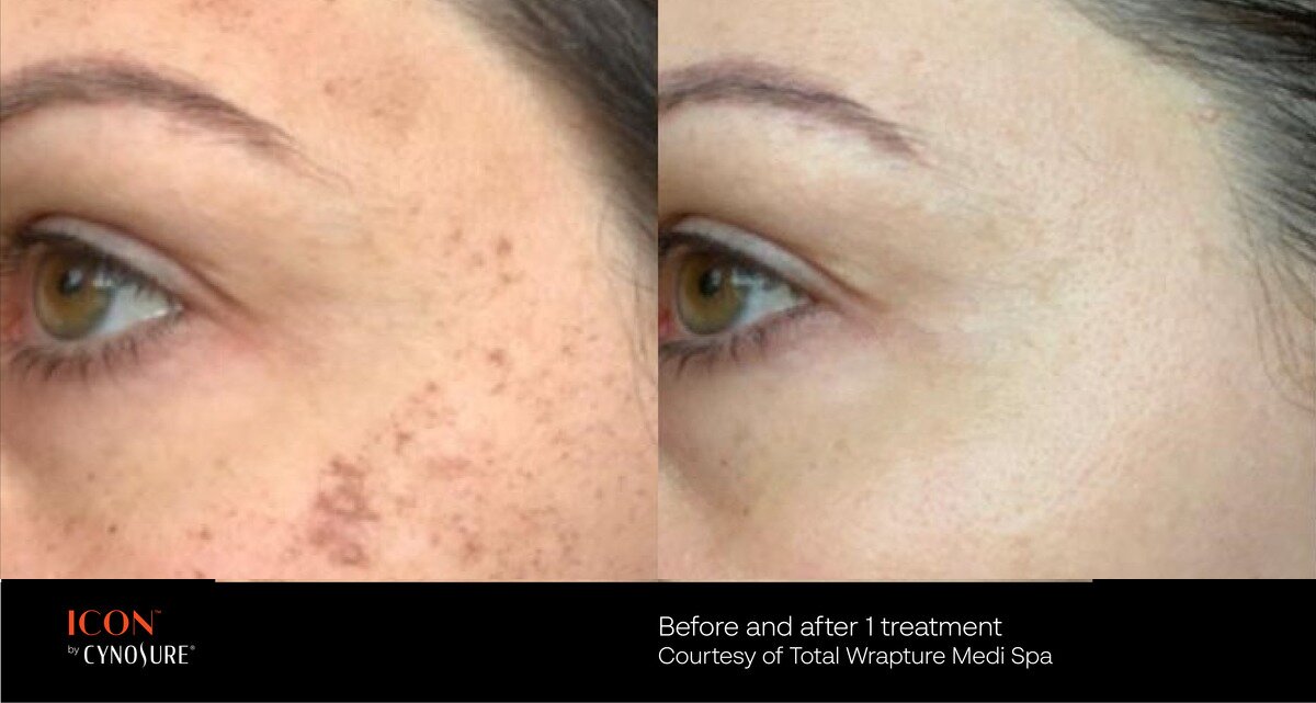 Photofacial IPL Before & After Image