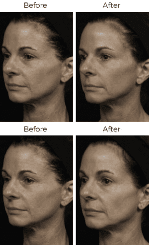 Thermage Before & After Image