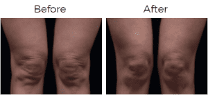 Thermage Before & After Image