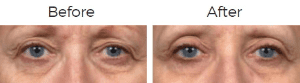 Thermage Before & After Image