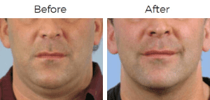 Thermage Before & After Image