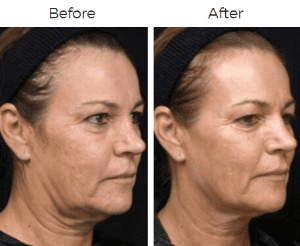 Thermage Before & After Image