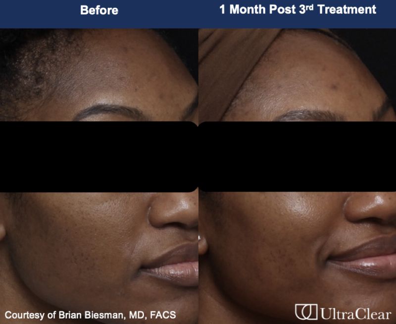 UltraClear Before & After Image