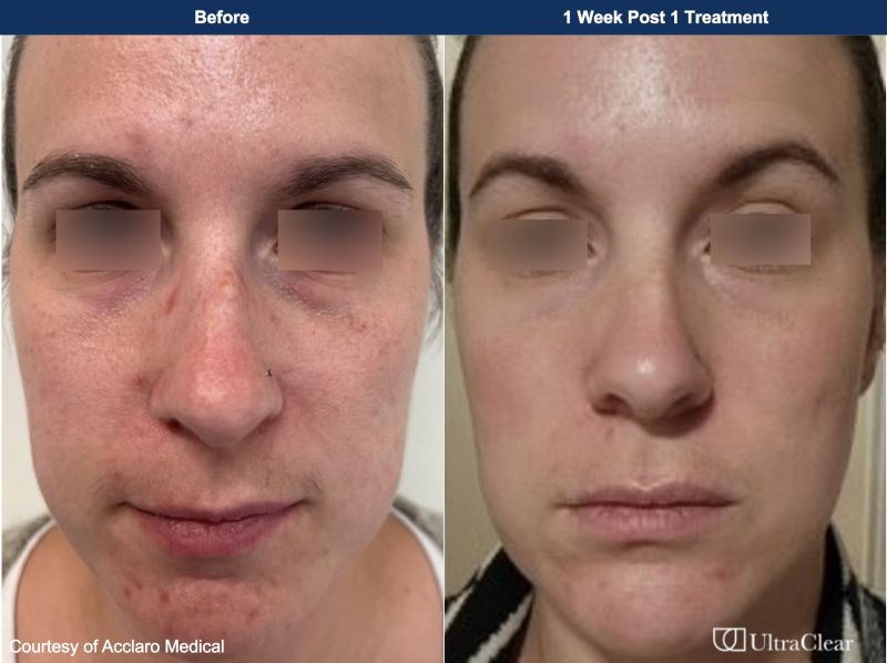 UltraClear Before & After Image