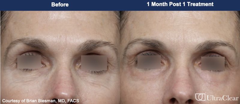 UltraClear Before & After Image