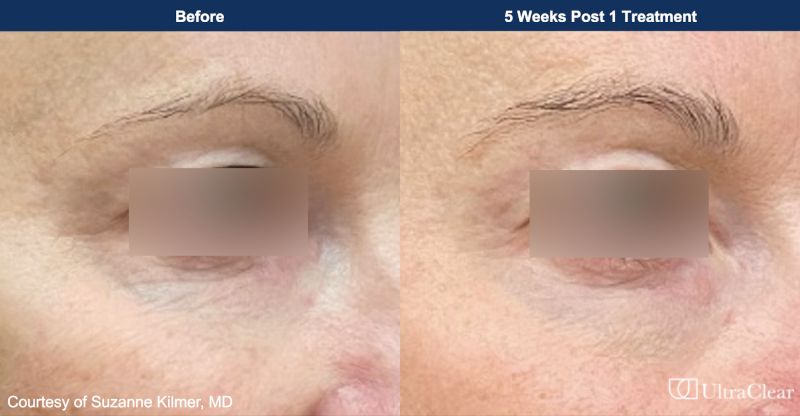 UltraClear Before & After Image