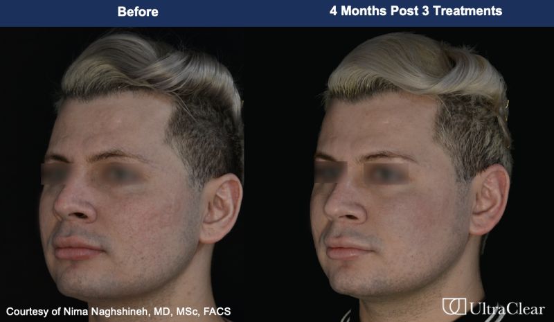 UltraClear Before & After Image