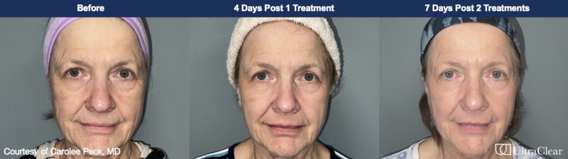 UltraClear Before & After Image