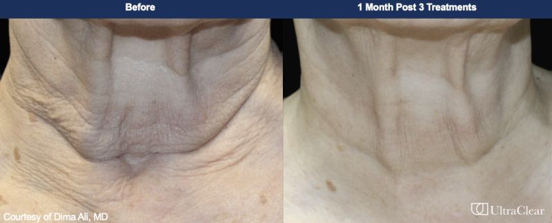 UltraClear Before & After Image