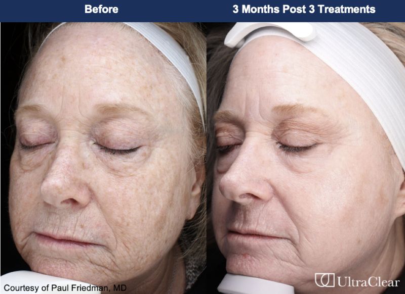 UltraClear Before & After Image