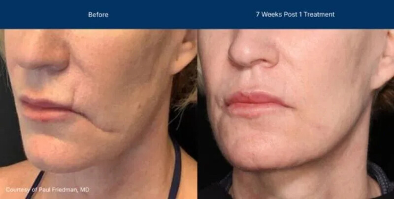 UltraClear Before & After Image