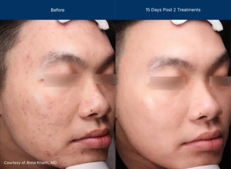 UltraClear Before & After Image