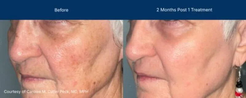 UltraClear Before & After Image