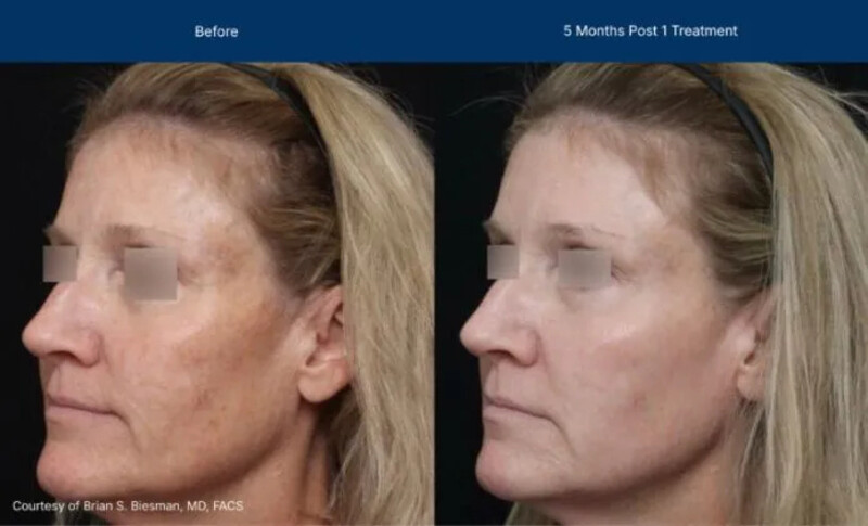UltraClear Before & After Image