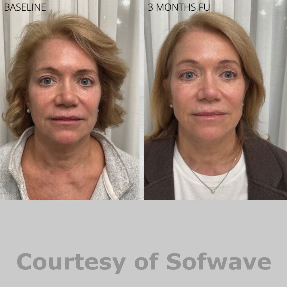 SofWave Before & After Image