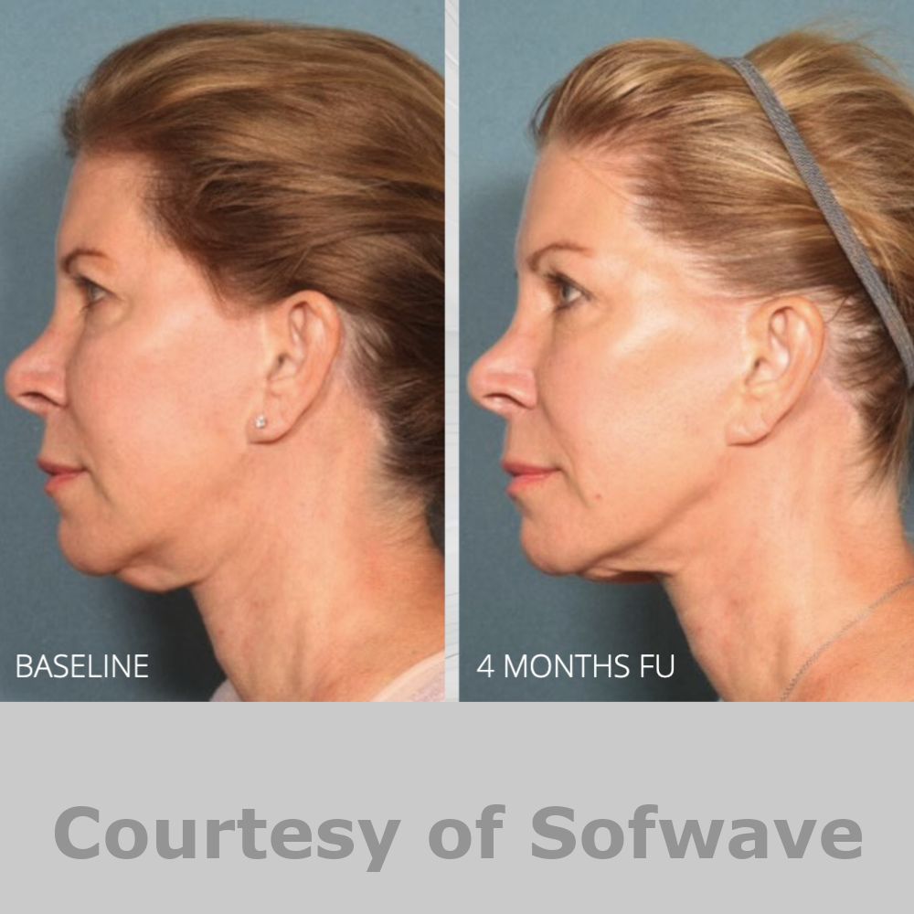 SofWave Before & After Image