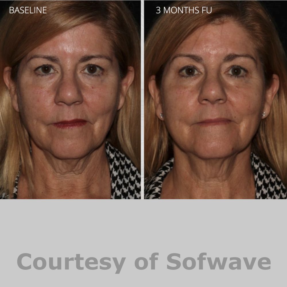 SofWave Before & After Image