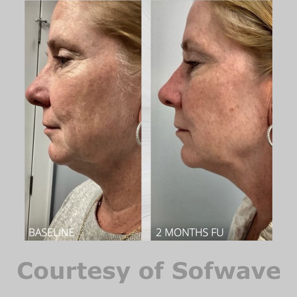 SofWave Before & After Image