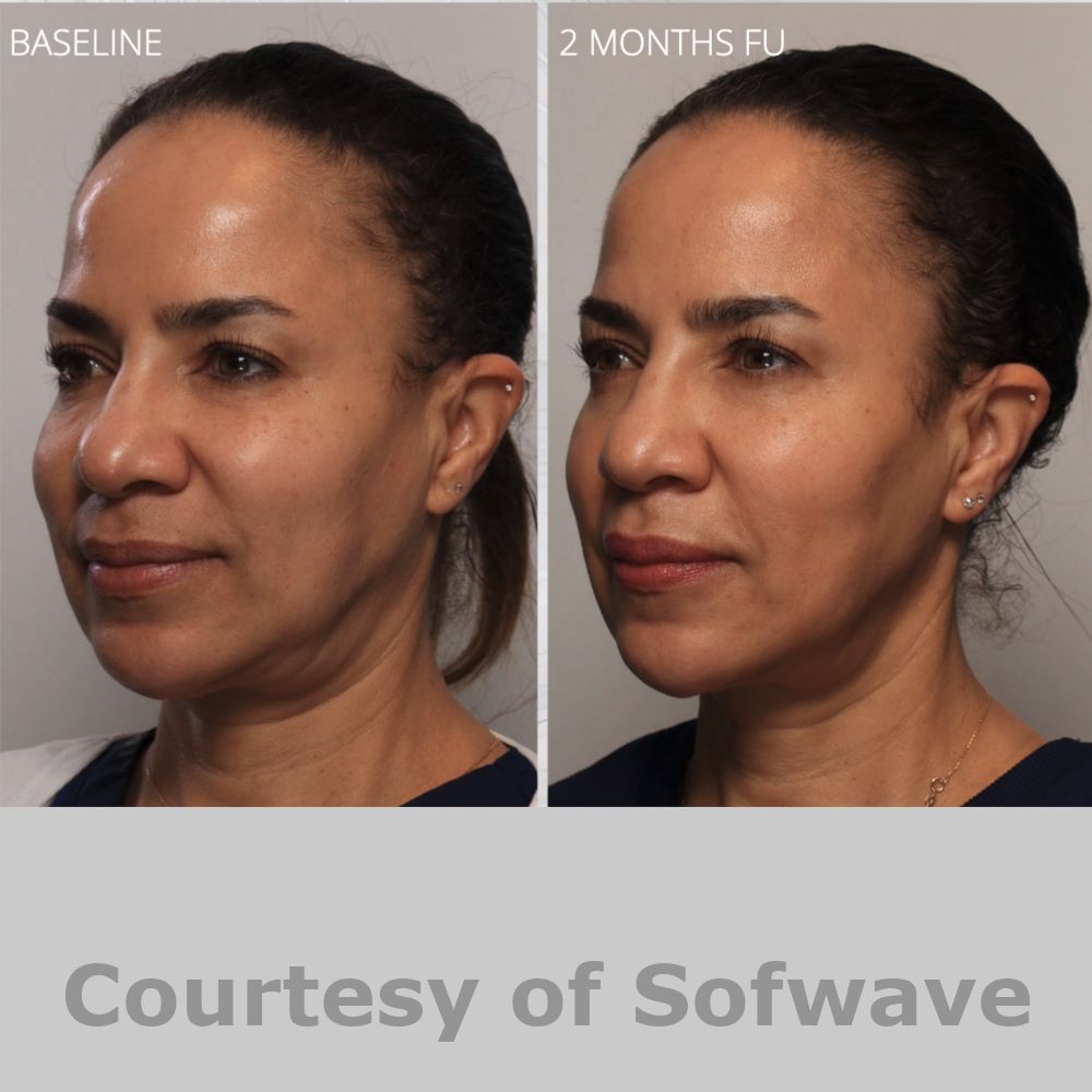 SofWave Before & After Image