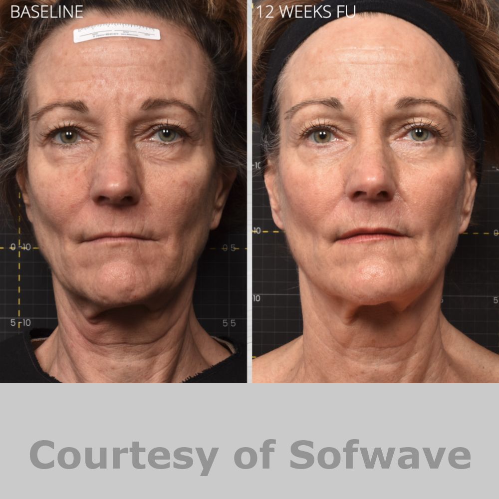 SofWave Before & After Image