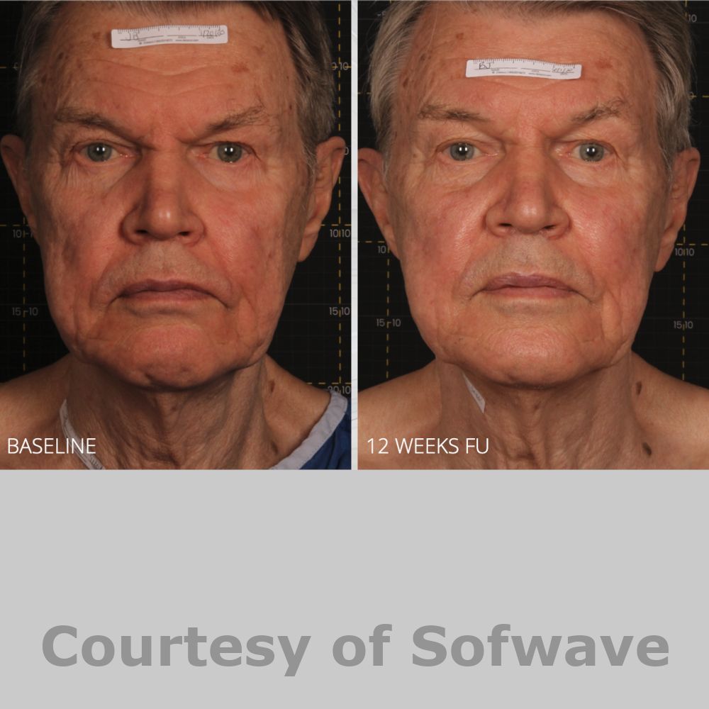 SofWave Before & After Image