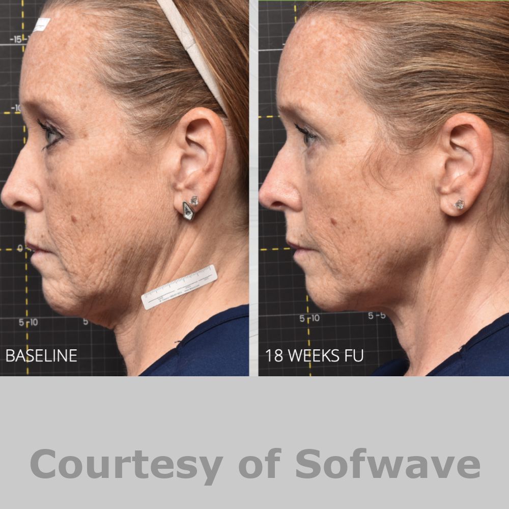 SofWave Before & After Image