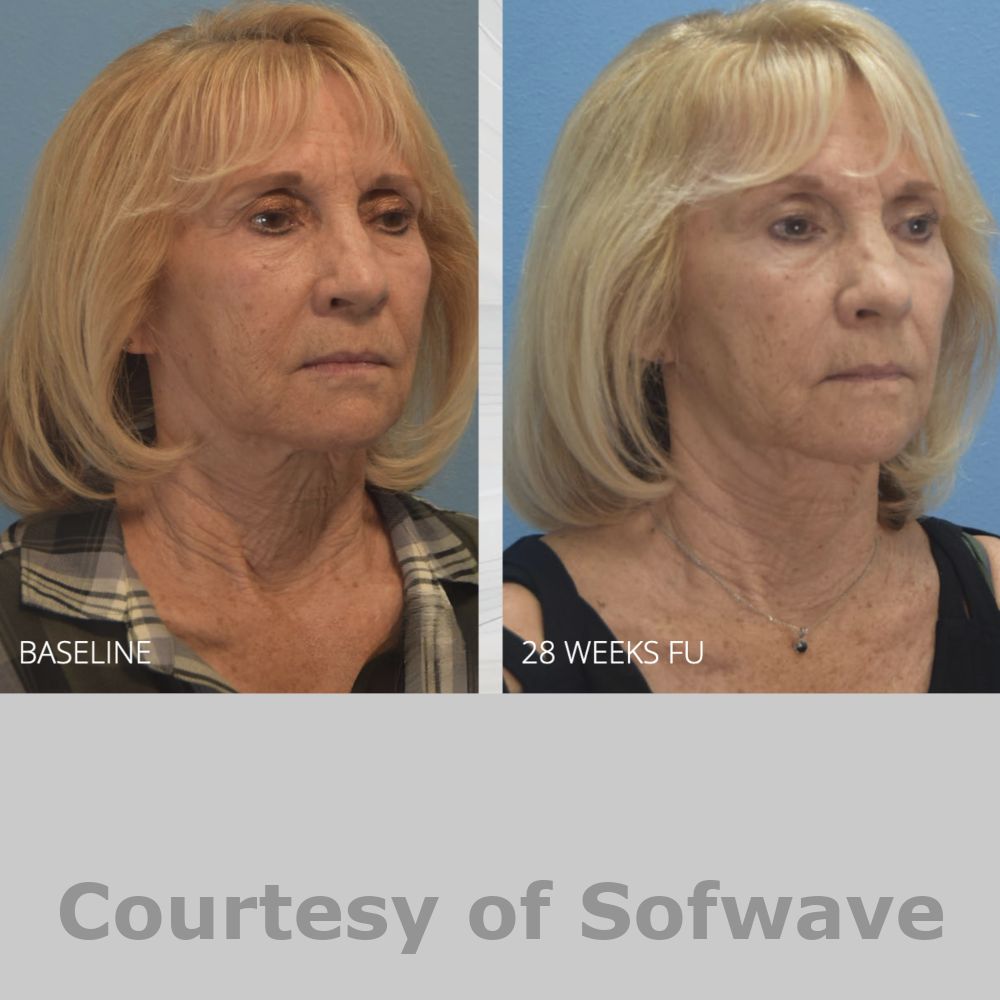 SofWave Before & After Image
