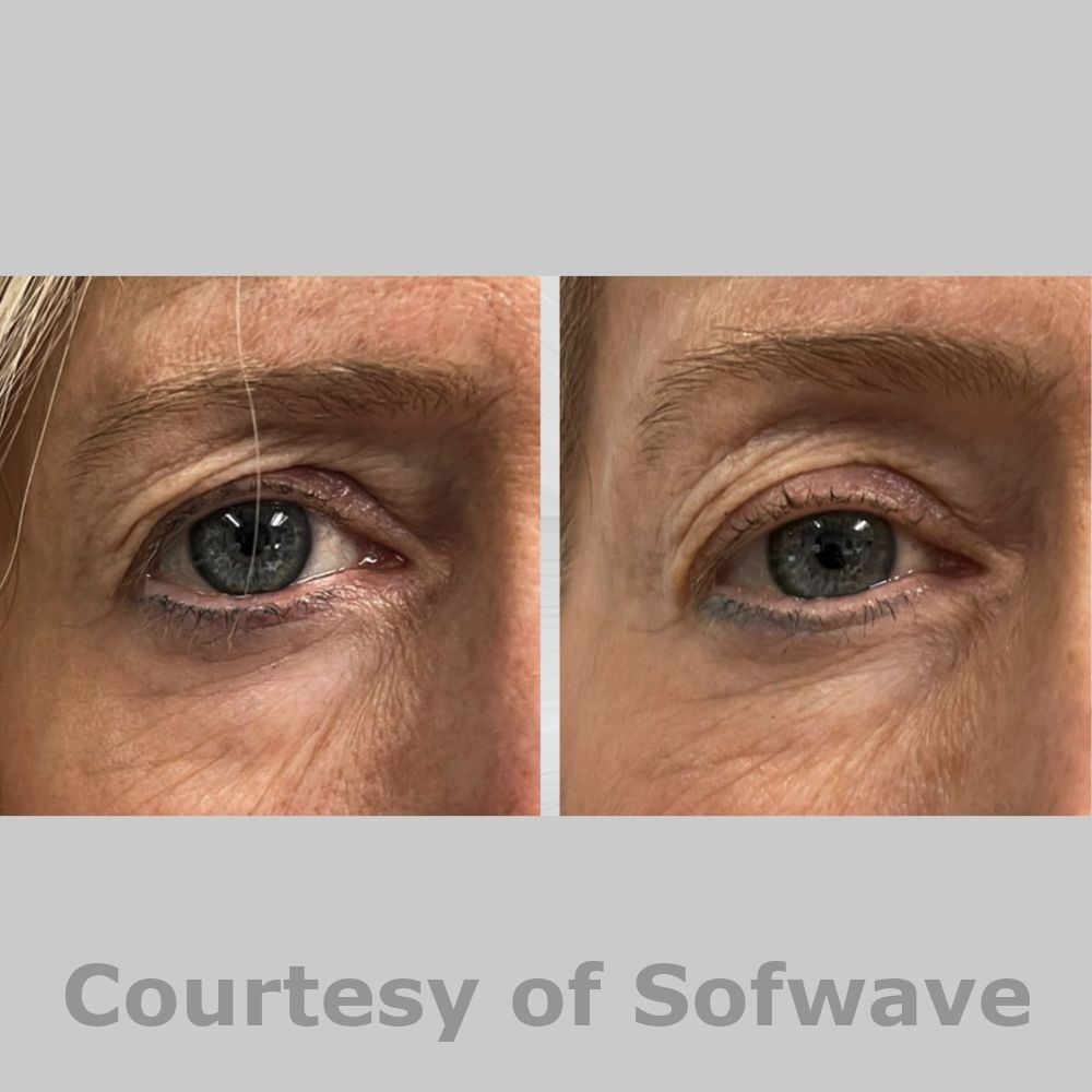 SofWave Before & After Image