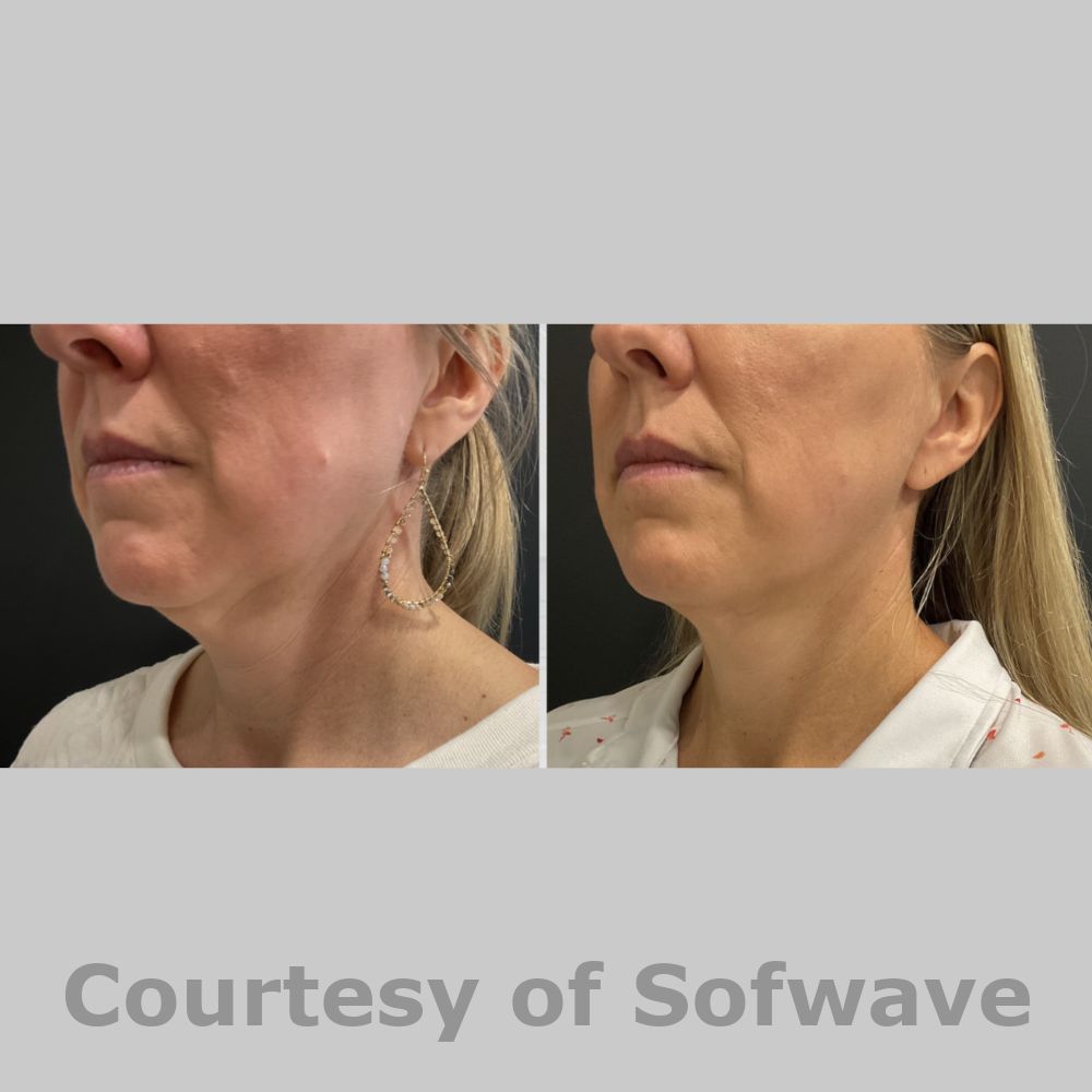 SofWave Before & After Image