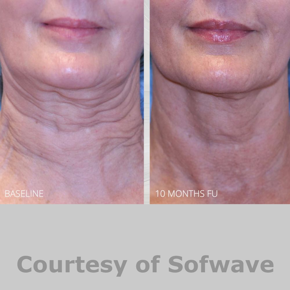 SofWave Before & After Image