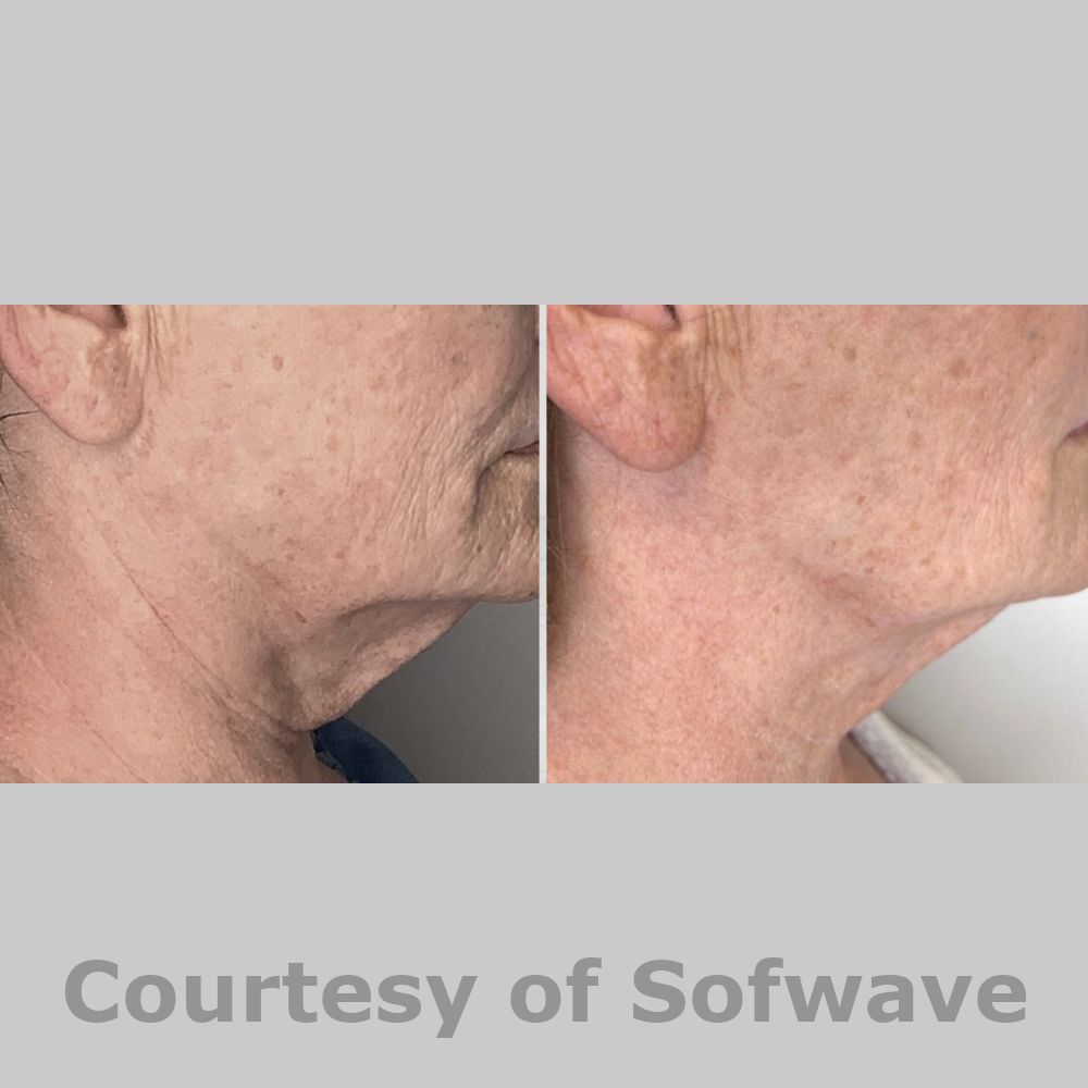 SofWave Before & After Image