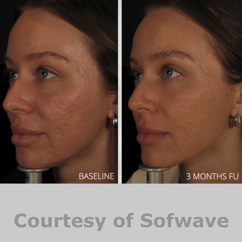 SofWave Before & After Image