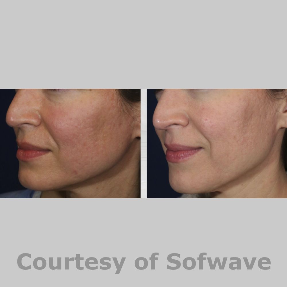 SofWave Before & After Image