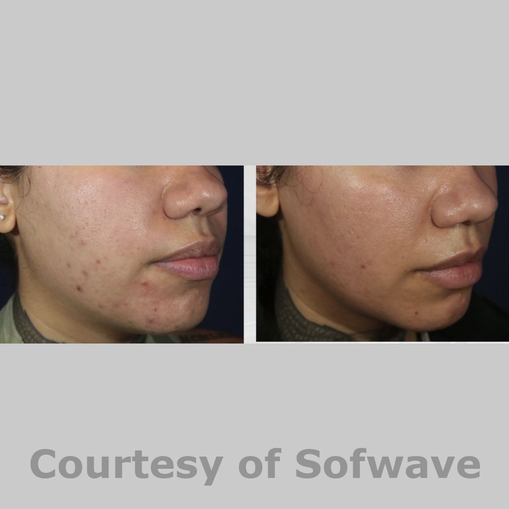 SofWave Before & After Image