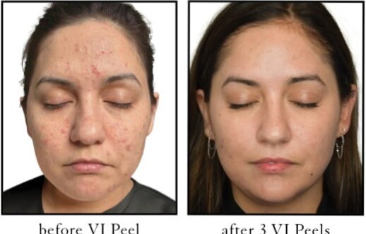 VI Peel Before & After Image