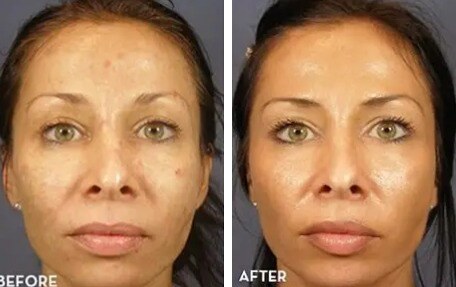 VI Peel Before & After Image