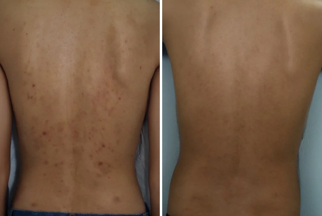 VI Peel Before & After Image