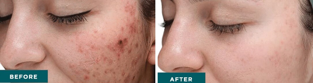 VI Peel Before & After Image